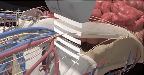 大腿神経ブロック | Sonosite Institute for Point-of-Care Ultrasound